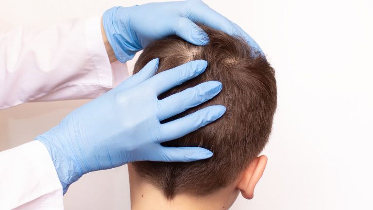How Do You Check An Adult Scalp For Head Lice?