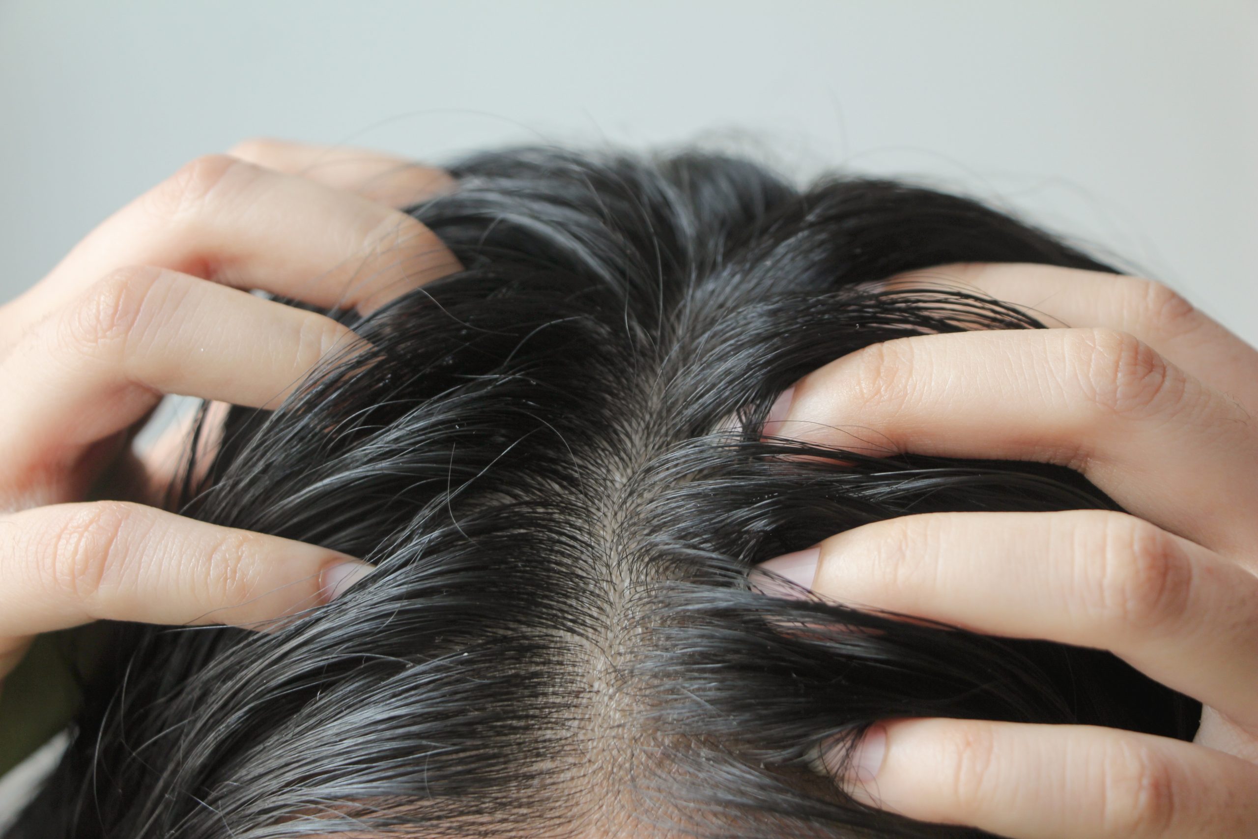 Close-up on head of Asian people have long black hair, having problems with greasy oily hair, showing scalp, scratching herself, dandruff problem.