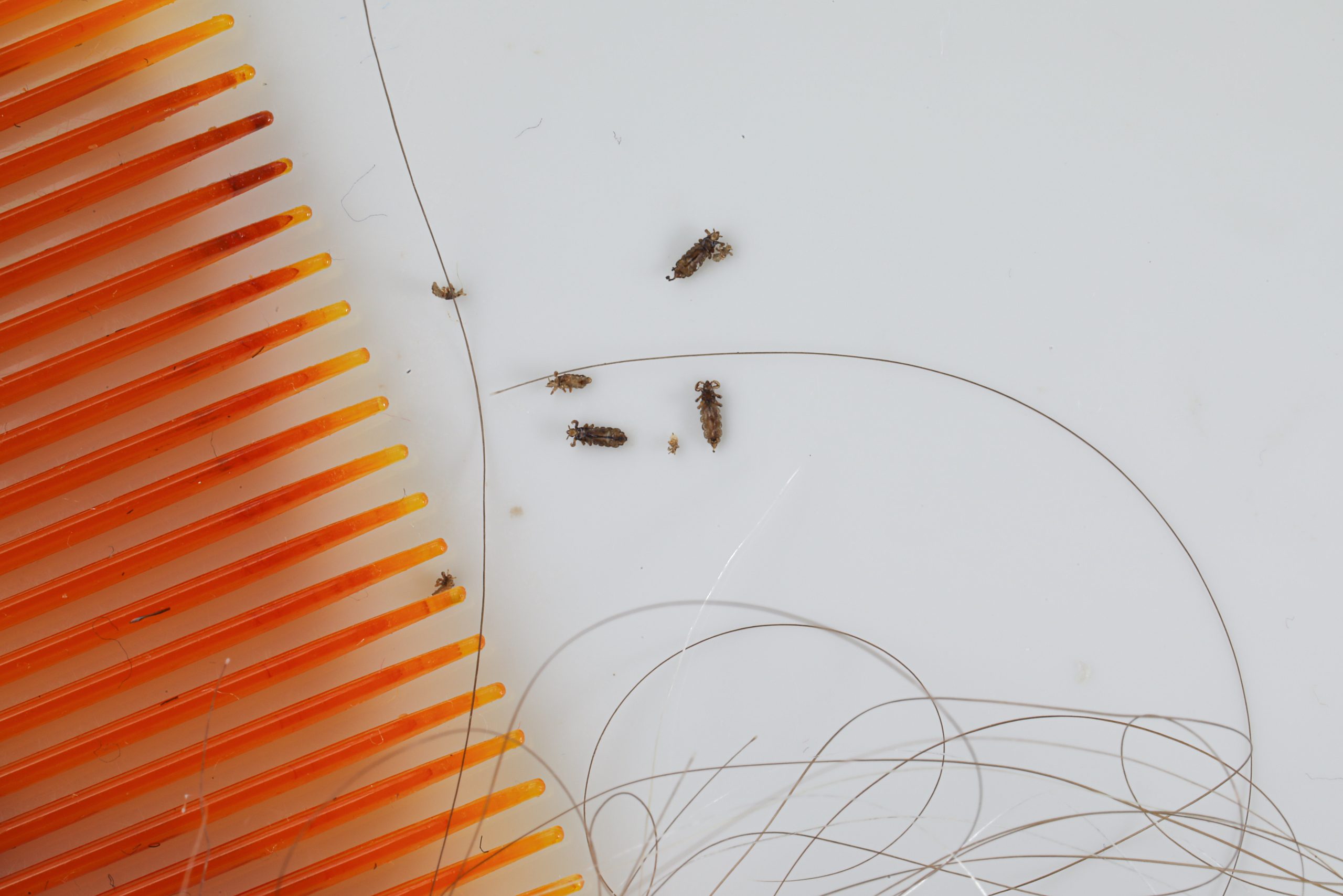 Head lice infestation requiring treatment and hygiene control